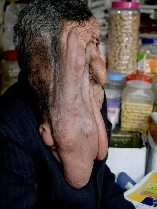 Penyakit Langka