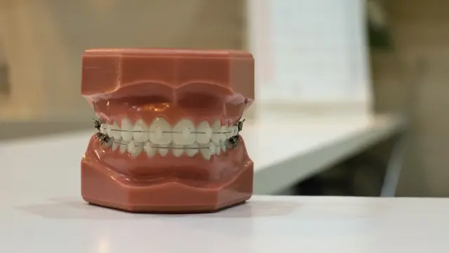 Ilustrasi bracket kawat gigi, behel