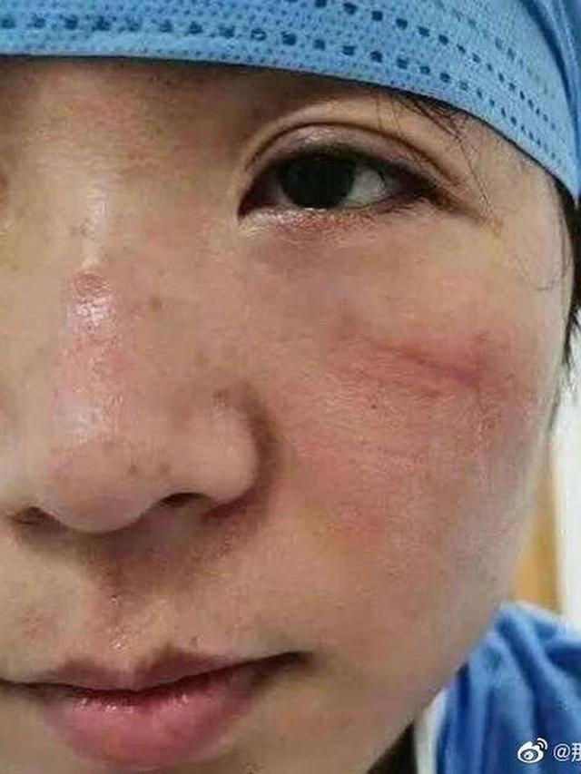 7 Potret Luka Lebam di Wajah Tim Medis Akibat Kacamata Pelindung Selama Perangi Virus Corona