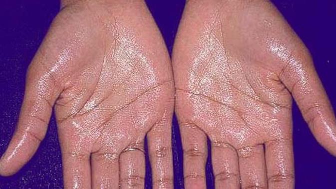 Kaki Dan Tangan Berkeringat Berlebihan Ini Penyebabnya Health Liputan6 Com