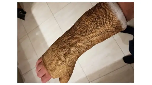Pergelangan Tangannya Cedera, Pria Ini Gunakan Hiasan Gips yang Unik