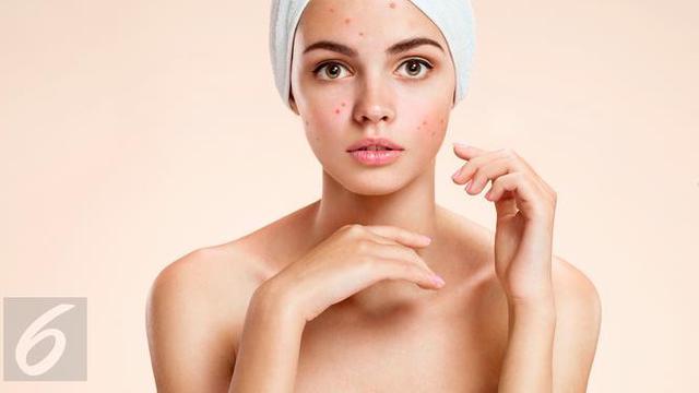 Manfaat Air Garam Untuk Atasi Jerawat Fashion Beauty Liputan6 Com