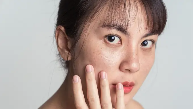 Wajah Rusak Akibat Jerawat? Begini Langkah-Langkah Mudah Memperbaikinya