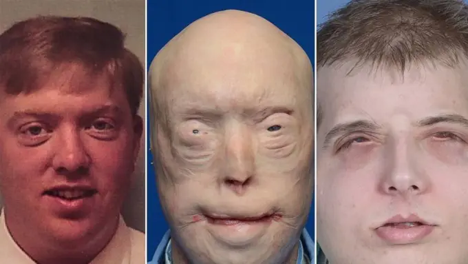 Pemadam Kebakaran Sukses Menjalani Transplantasi Wajah