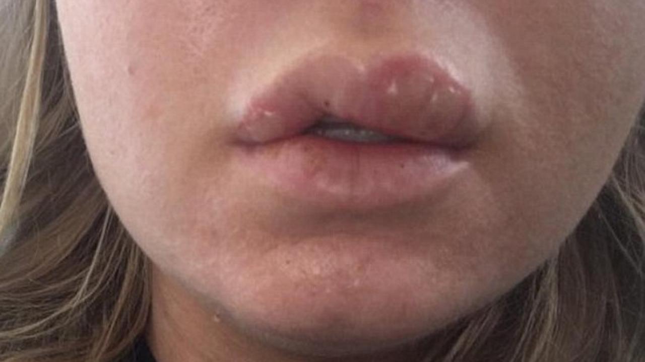 Akibat Gunakan Kosmetik Tiruan, Bibir Wanita Ini Bengkak Parah