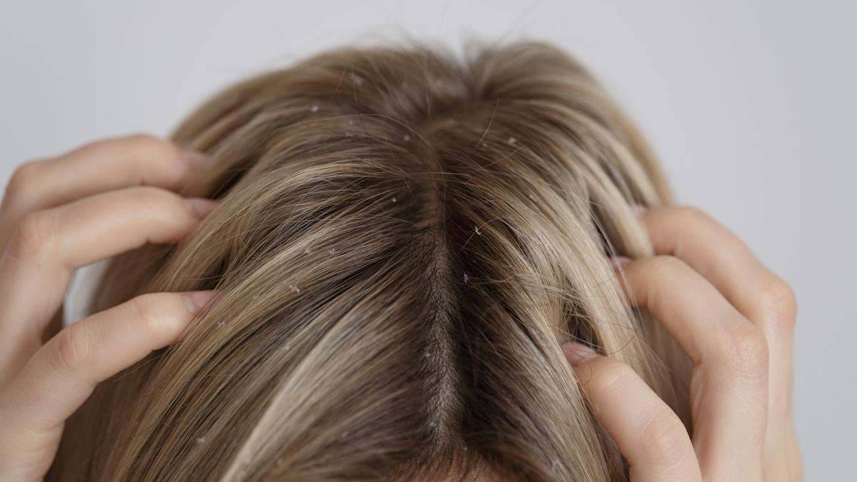 Cara Mengatasi Ketombe yang Tak Kunjung Hilang