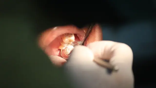 Ilustrasi Gigi berlubang