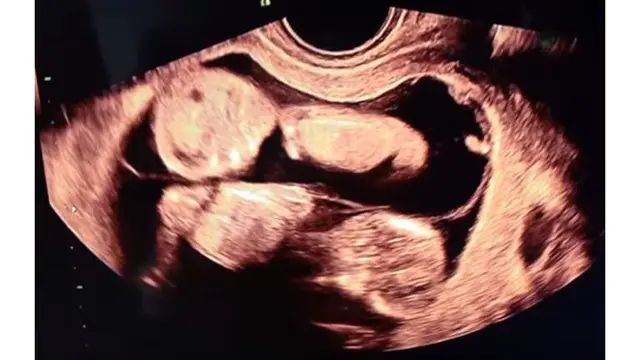 5 Momen Bahagia Ammar Zoni dan Irish Bella Saat Umumkan Hamil Anak Kembar