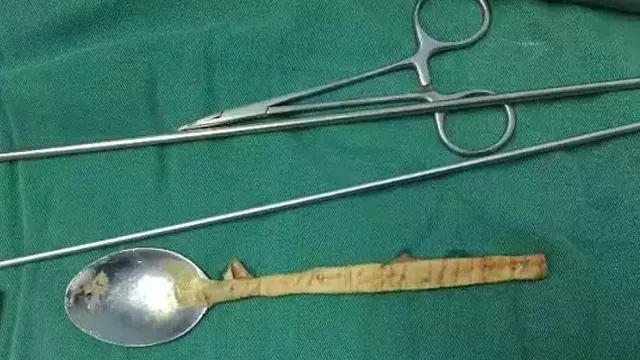 Akibat Mabuk, Pria Ini Telan Sendok Logam dan Tersangkut di Kerongkongan