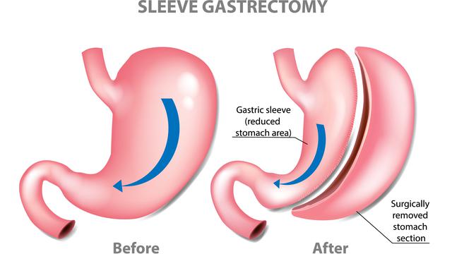 sleeve gastrectomy