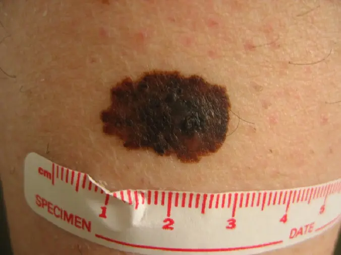 Diameter pada bintik ataupun tahi lalat dalam kulit juga perlu diperhatikan. Source: Transplant Skin Cancer Network