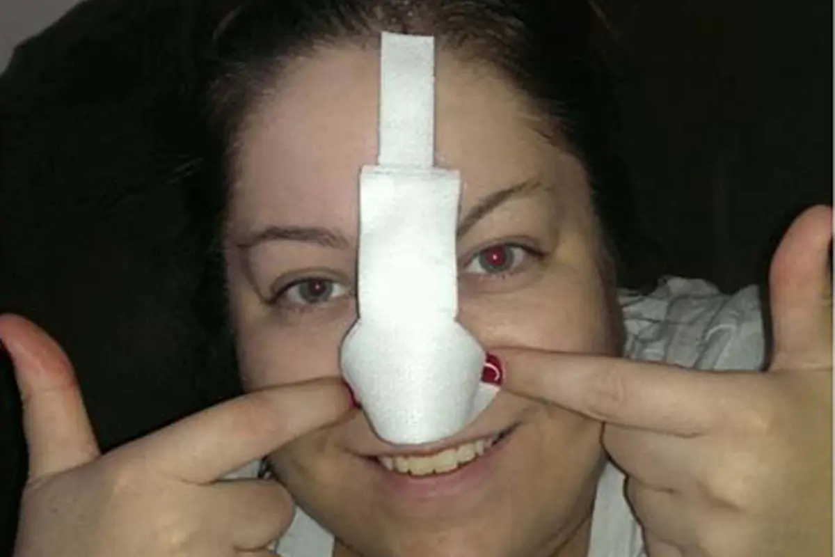 Karena Kanker Kulit, Perempuan Ini Punya Hidung Berbulu Lebat