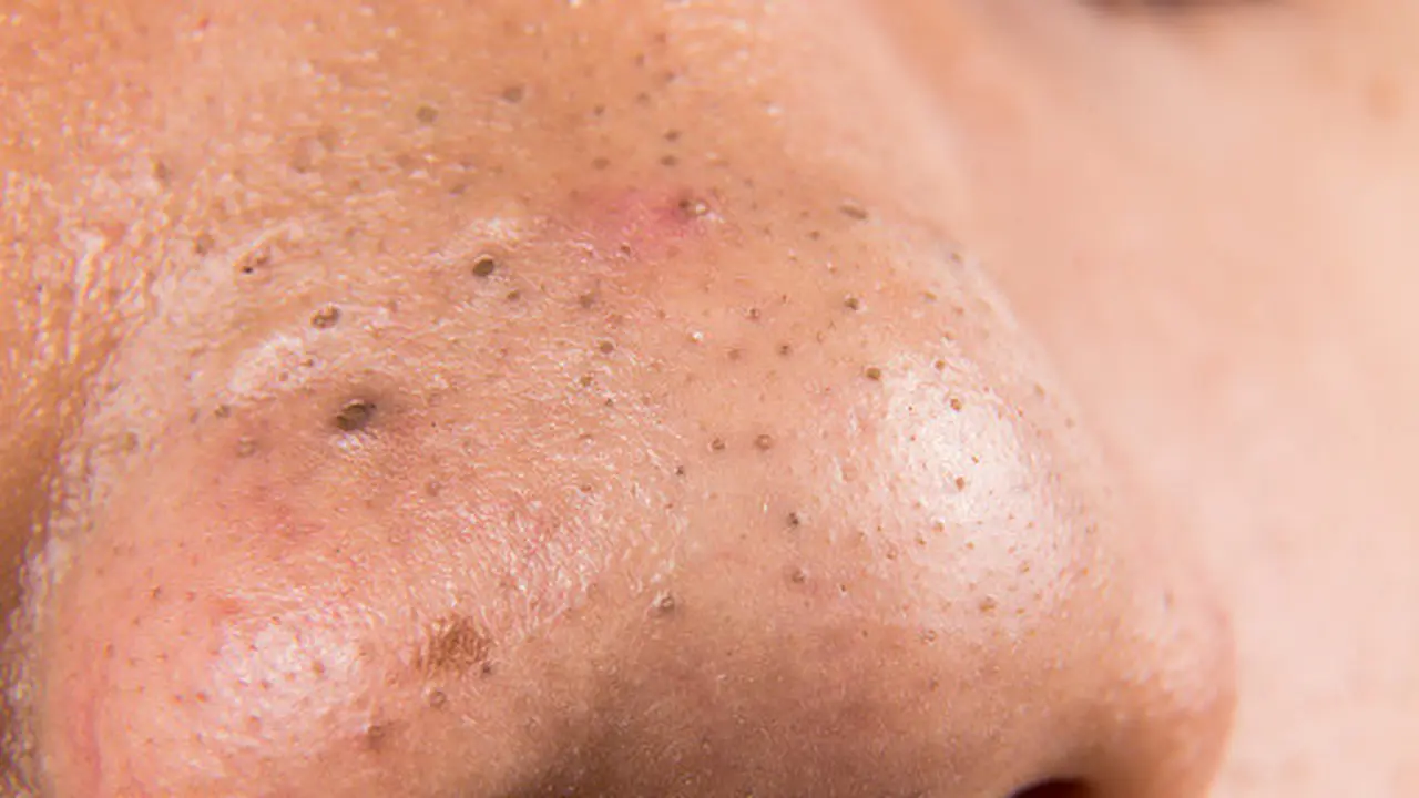 Mengenal Jerawat dan Ragam Jenisnya, Mulai dari yang Terkecil hingga