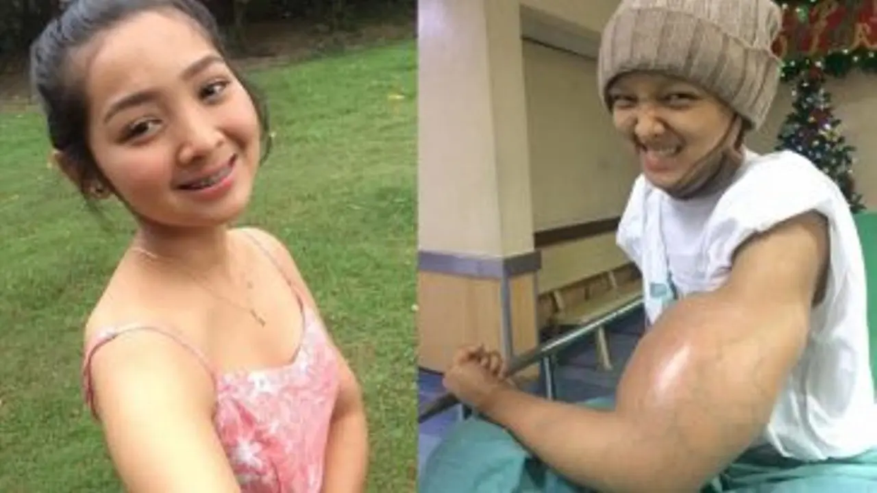 [Bintang] Satu Tangan Diamputasi karena Kanker, Gadis Cantik Ini Berbagi Kisah Hidupnya di Media Sosial
