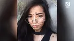 Meski sejak kecil sering dicemooh karena tanda lahir di tubuhnya, gadis berusia 20 tahun ini tersebut tetap percaya diri.
 
