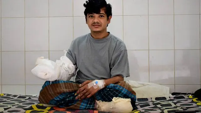 Abul Bajandar Manusia Pohon