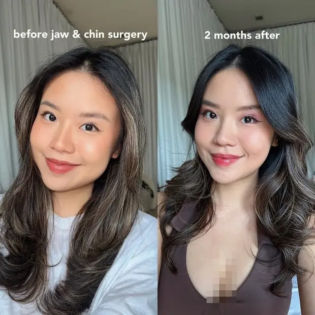 Ingin Mirip Jennie, Ini 6 Potret Selebgram Titan Tyra yang Viral Operasi Potong Rahang