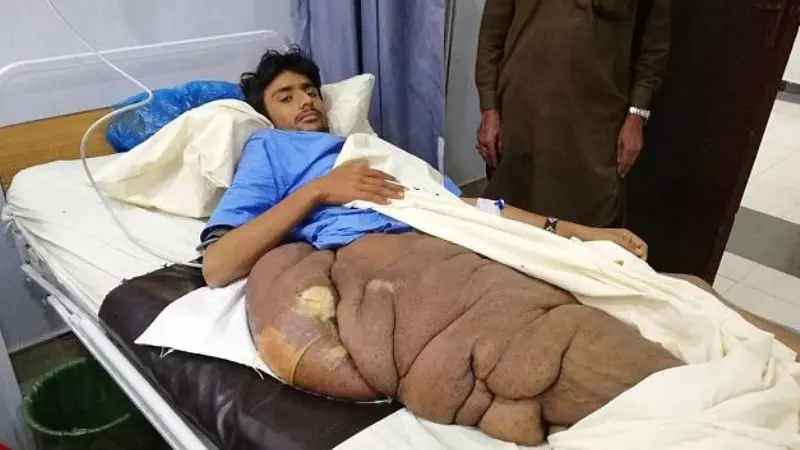 Miliki Tumor 20 Kg di Kaki, Remaja Harap Bantuan Pengobatan