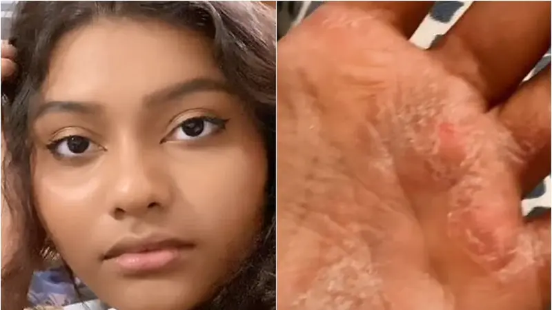 Perempuan berusia 17 tahun menderita psoriasis dan kondisinya makin parah usai pakai hand sanitizer