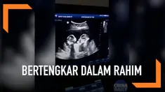 Sebuah video USG viral menunjukkan bayi kembar perempuan bertengkar di dalam rahim. Ini terjadi ketika sang ibu tengah memeriksakan kehamilannya.