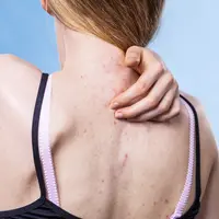 berbagai penyebab timbulnya jerawat pada punggung/shutterstock/voyagerix