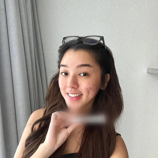 6 Potret Wajah Gabriella Ekaputri Berjerawat, Tetap Percaya Diri Tampil Natural