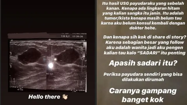 Kesha Ratuliu Diduga Idap Tumor Payudara, 7 Artis Ini Pernah Alami Penyakit Sama