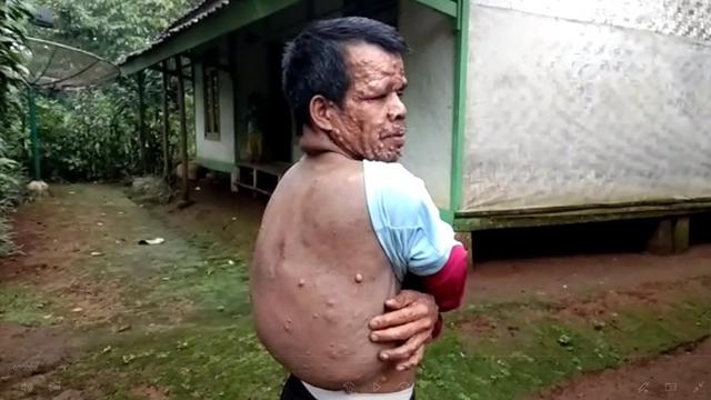 Teten, Pria dengan Kutil di Sekujur Tubuh