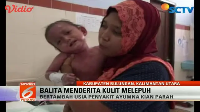 Balita di Kalimantan Utara Menderita Kulit Melepuh