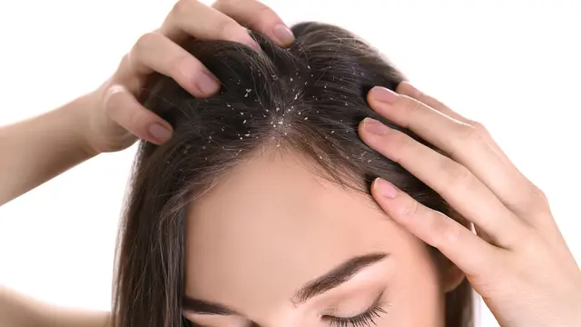 Sebelum Pilih Shampo Anti Ketombe, Ketahui Penyebab dan Gejala Rambut Ketombe