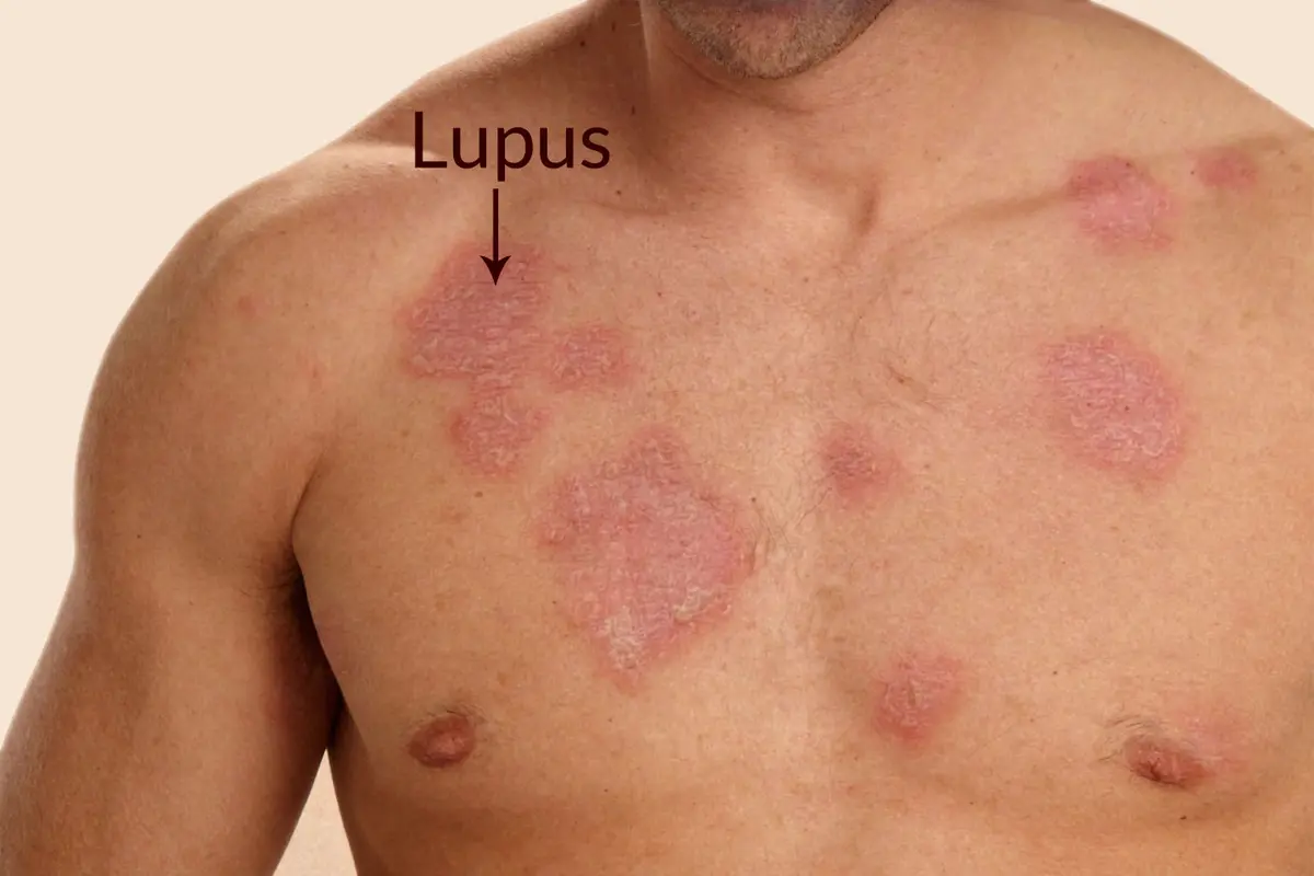 7 Fakta Tentang Penyakit Lupus yang Mungkin Belum Kamu Ketahui