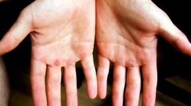 Cara Menghilangkan Kulit Kapalan Di Tangan Dan Kaki Dengan