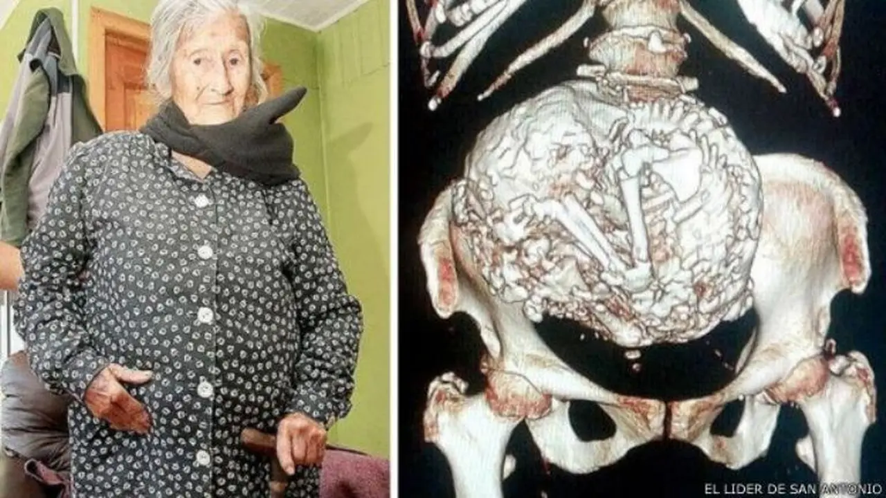 Dikira Tumor, Ternyata Nenek Ini Hamil Bayi yang Telah Mati