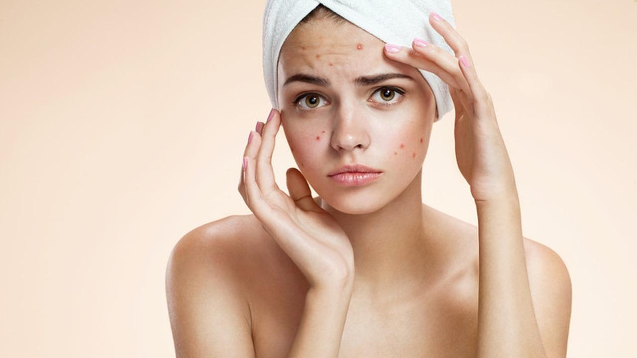 Ilustrasi jerawat batu | Pexels