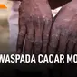 Waspada Cacar Monyet Yang Ditularkan Hewan Liar