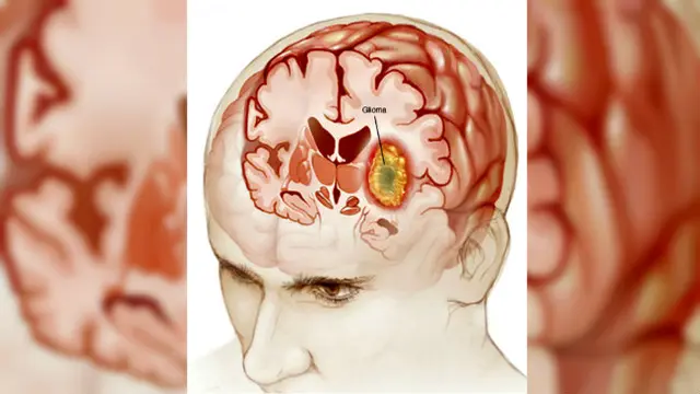 Harapan Miliki Keturunan Pada Bocah Tumor Otak
