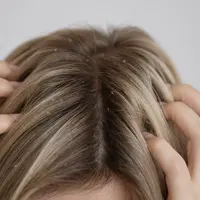 Ketombe Tak Kunjung Hilang, Berikut Cara Mengatasinya