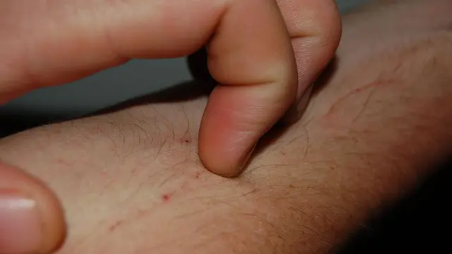 Ekbom's syndrome