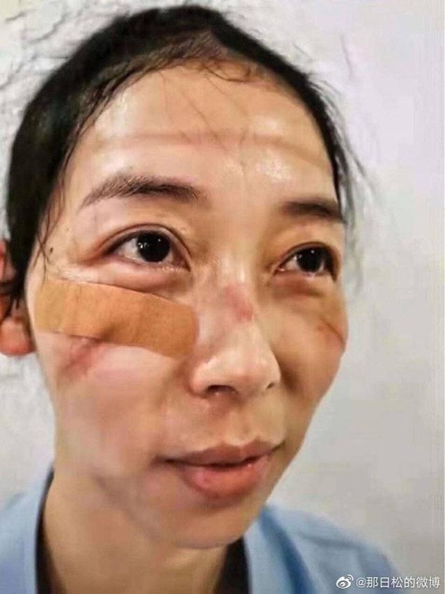 7 Potret Luka Lebam di Wajah Tim Medis Akibat Kacamata Pelindung Selama Perangi Virus Corona