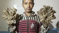 Abul Bajandar si 'manusia akar' dari Bangladesh. (Zuma Wire)