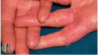 Penyakit kulit | via: arwinokwandiclinic.blogspot.com